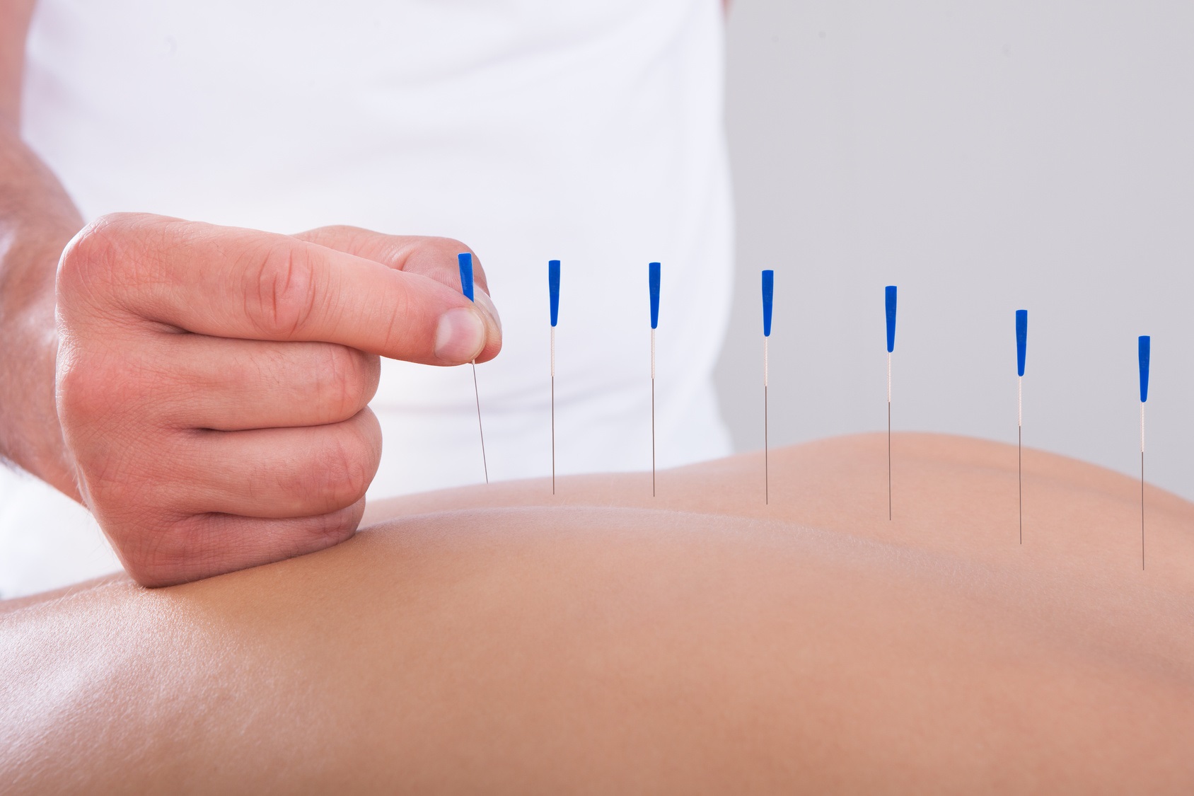 Young Beautiful Woman In An Acupuncture Therapy In A Spa Center